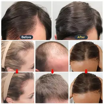 Масло за бърз растеж на косата, серум за растеж на косата, лекарство за лечение на фоликули от косопад, масло за гъст растеж на косата за мъже и жени за възстановяване на косата Масло за бърз растеж на косата, серум за растеж на косата, лекарство за лечение на фоликули от косопад, масло за гъст растеж на косата за мъже и жени за възстановяване на косата 1